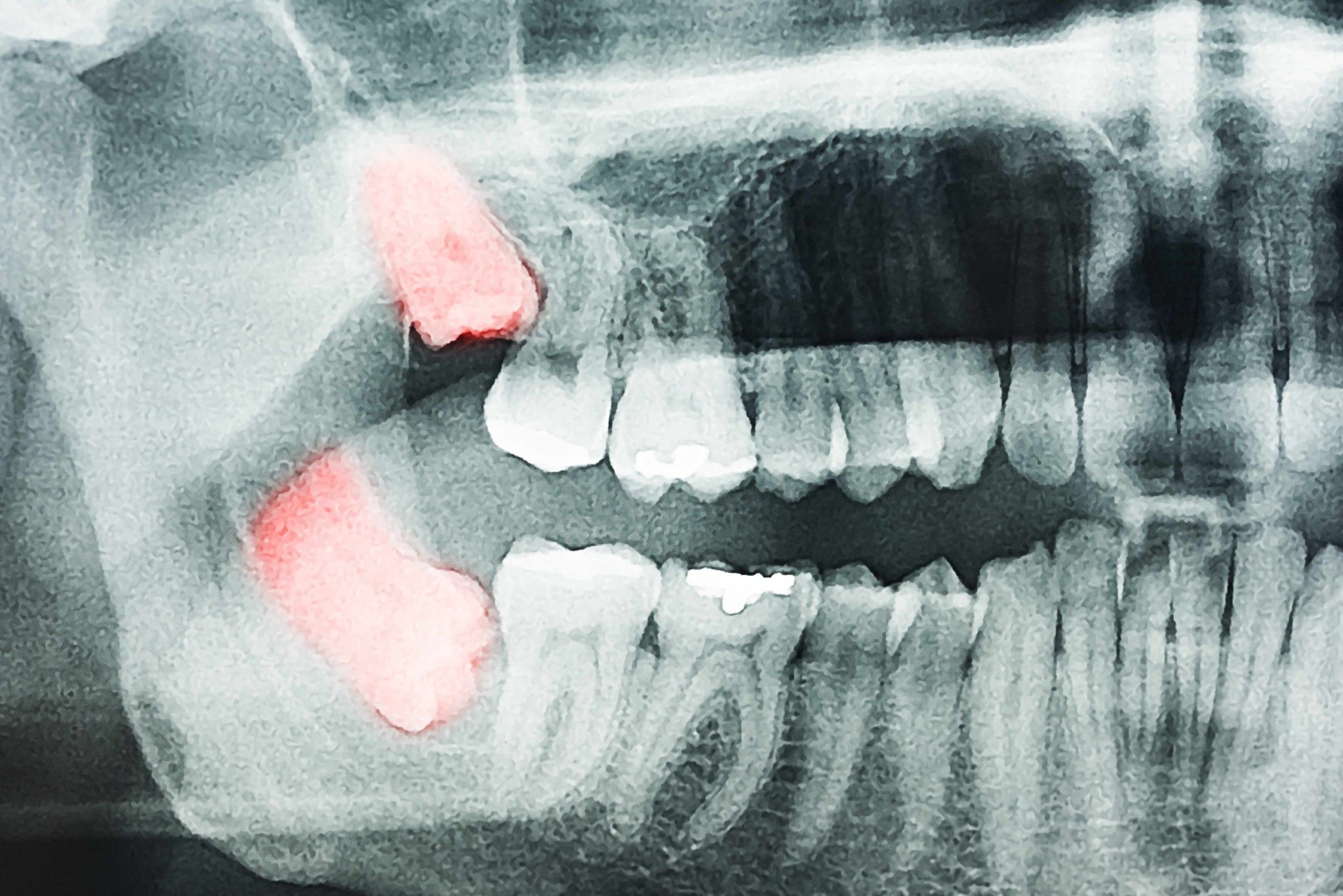 Ретинированный зуб на рентгенограмме
